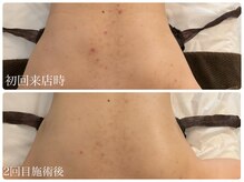 ブリエ(Briller)/お背中のハーブ2回目の効果☆