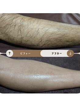 ジュゴン(Dugong)/足の全体脱毛（Before＆After）