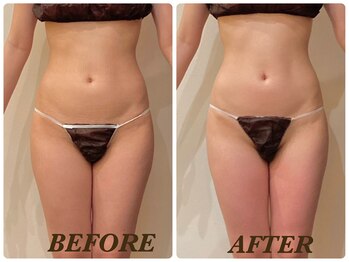 プリマ(Prima)/【2回施術】 BEFORE&AFTER