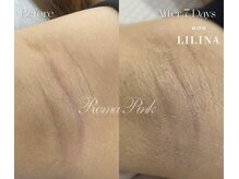 ウィズリリナ 新横浜(with Lilina.)/ローマピンク 症例　途中経過