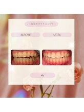 プラスビーセルフ(+b self)/ホワイトニングビフォーアフター