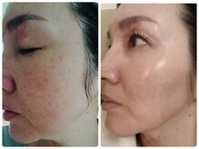 アズ(AZU)/肌改善Before after