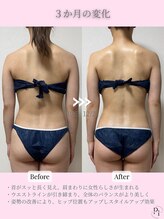 プラスワンビューティテン 新大阪店(Plus One Beauty)/ボディ/ハイパーナイフ/痩身