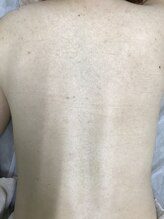 ナノハナ/鹿沼市の全身脱毛のナノハナ