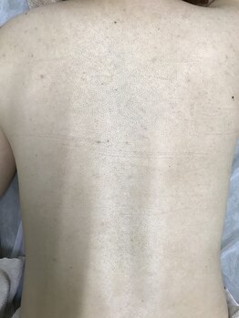 ナノハナ/鹿沼市の全身脱毛のナノハナ