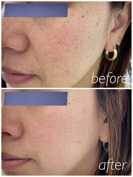 シス(SiS)/ハーブピーリング