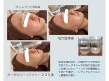 サロンドエピレーション トパーズ(Salon d’ epilation TOPARDS)/フェイシャルフルコースで毛穴◎