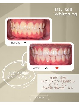 スリール(sourire)/ホワイトニングビフォーアフター