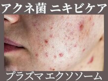 マヴィ 守口店(MavY.)/ニキビのお悩みには！