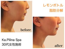 カピリナスパ(Ka.Pilina Spa)/レモンボトル　before⇒after
