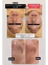 クレール 小山店(CLAIR)/【毛穴洗浄・美容液導入】