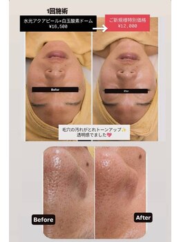 クレール 小山店(CLAIR)/【毛穴洗浄・美容液導入】