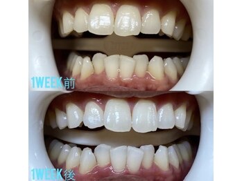 ホワイトニングセンター 京都長岡京店/長岡京・大山崎ホワイトニング