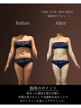 レディラック 大阪梅田本店(Lady Luck)/がっつりサイズダウンコース