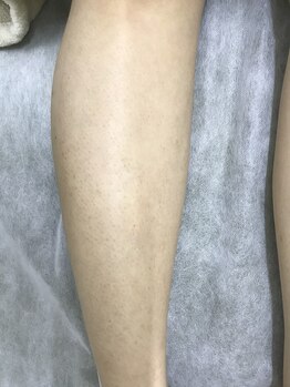 ナノハナ/鹿沼市の全身脱毛のナノハナ