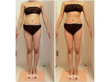 ティアラ/一回の施術でくびれウエストに！