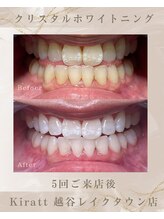 キラット 越谷レイクタウン店(Kiratt)/ビフォーアフター　6