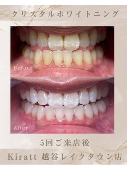 キラット 越谷レイクタウン店(Kiratt)/ビフォーアフター　6