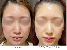 ビボーラ(BEBEAURA)/☆エクソソームフェイシャル☆