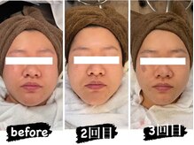 サロン ド パーフェクション(Salon de Perfection)の雰囲気（【人気No. 1】効果◎最強小顔は勿論！肌質改善にも◎）