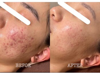 リス ブラン(Lys Blanc)/ハーブピーリング