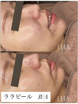 ミセルビューティー 御堂筋本町(micell beauty)/ララピール