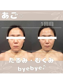 ラフィズム 竹ノ塚店(Raphism)/『あご』に注目☆