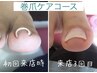 【巻爪にお悩みの方向け】巻き爪補正ケアコース【補正2本】