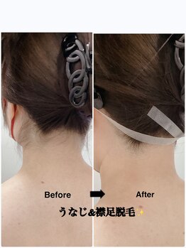メディカルサロンドオフ 堺東店(medical salon de off)/うなじ＆襟足脱毛