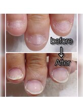 ネイルクロスラニ 練馬店(Nail Lani)/深爪矯正は当サロンにお任せ