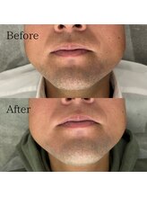 シェアキ(Chez Aki)/メンズヒゲ脱毛Before/After