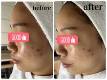 ニュウ(Nyu)/剥離なし☆ハーブピーリング