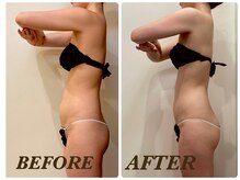 プリマ(Prima)/【2回施術】　BEFORE&AFTER