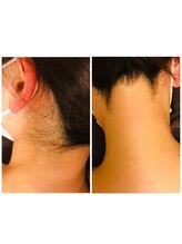 フェルン(FERUN)/うなじの毛