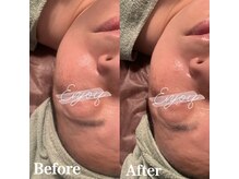 ルーチェ(LUCE)/贅沢肌別パック小顔フェイシャル