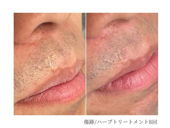 ルーム(room)/ハーブトリートメント8回