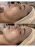 【毛穴ケア/リフトアップ】韓国式小顔術とカーボキシーで引き締め&細胞強化!