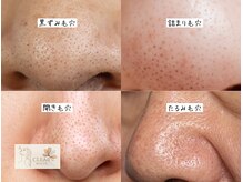 クリアホワイト(Clear White)/毛穴悩みは人それぞれ