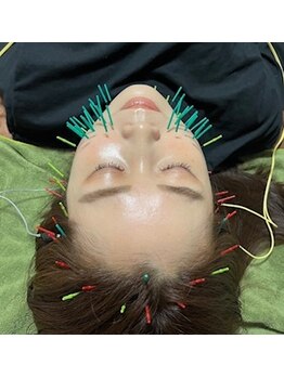 アディクト(Addict)の写真/超小顔！！！美容鍼でしか出ない『小顔』感を体験してください☆小顔/たるみ/ほうれい線/リフトアップ