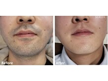 ララリア(LaLaLia)/ひげ　ビフォーアフター