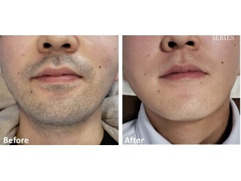 ララリア(LaLaLia)/ひげ　ビフォーアフター