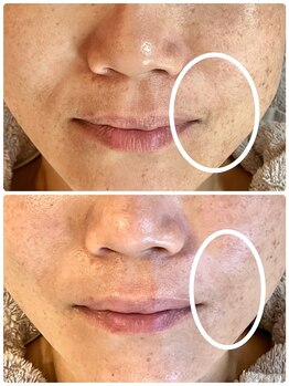 エステティックジュビラン アンビエンテ 福井南店/ほうれい線改善