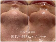 キアラ(CHIARA)/ハイドラフェイシャル