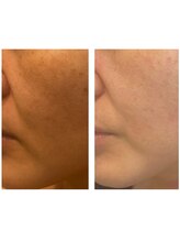 アドビューティ(Add Beauty)/≪たるみ改善／RFリフティング≫