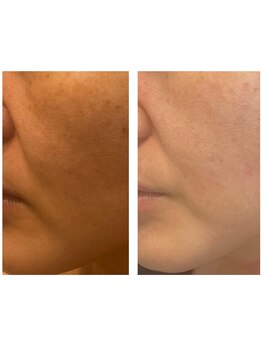 アドビューティ(Add Beauty)/≪たるみ改善／RFリフティング≫