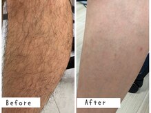 セルフメイド 高崎店(SELFMADE)/男性の足脱毛　清潔感UP◎