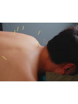 鍼灸施術を受けたい