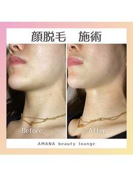 アマナ(AMANA)/顔脱毛でお化粧ノリもUP♪