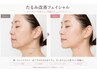 No1人気 【たるみ・ほうれい線】 5歳若見えリフトUP ￥25000→15000