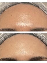 ビーメイクス(B・Makes)/プラズマしわ改善